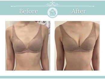 美人バスト 静岡店/バストアップ症例