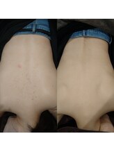 ボーソリューション(Beau-Solution)/【20代　背中肌荒れケア】