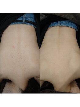 ボーソリューション(Beau-Solution)/【20代　背中肌荒れケア】