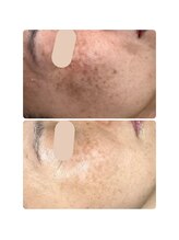 ハク(HAKU)/自信を取り戻せるお肌へ