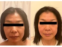 ルポ 那覇(repos)/電気美容鍼