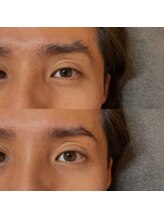 アイラッシュ ティル(eyelash till)