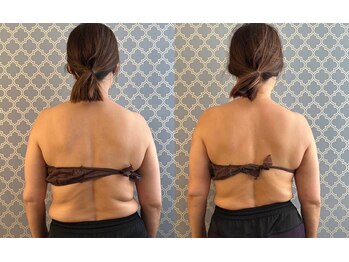 マイティー整骨院 ココア(CoCoa)/肩甲骨洗浄