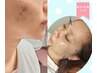 【肌荒れニキビにお悩みの方】美容鍼でツルツル肌に