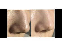 ハイドラ毛穴洗浄で毛穴スッキリしまったなめらかなおはだに！