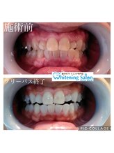 シフォン 豊田店/セルフホワイトニング豊田市