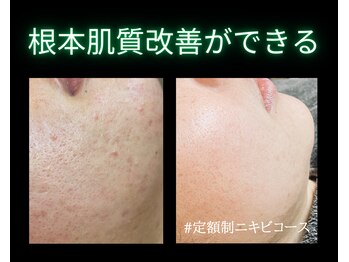 リオル(Rior)の写真/最速でツヤ肌×毛穴レス！ダウンTありハーブピーリング★劇的7日間で肌改善ができる人気No.1メニュー◎