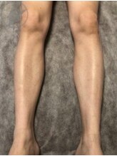 ダイアナ 出雲店(Daiana)/ひざ下★4回照射