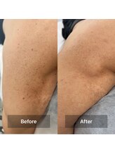 ビアラ(VIALA)/光フェイシャル