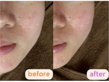 サクラ(SAKURA)/小顔矯正♪