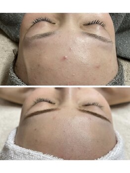 エン(O'en)/ハーブピーリング