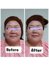 プロジェクトサン ムーンベル(PROjECTSuN Moonbell)/ラジオ波＋ポレーション