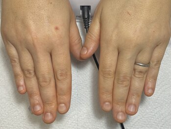 ミコ(.mico)の写真/【老若男女大歓迎！育爪、美爪、深爪、巻き爪】自信を持って人前に出せる手に！幅広い層から支持◎