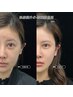 シラン純×水光導入ケア ～小顔・リフトアップ・ハリ肌効果～