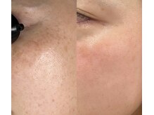 ハーブピーリングで肌質改善♪剥離なしと剥離あり両方あり☆