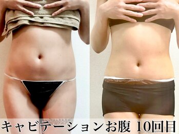 アトレセカンドボディ(Attrait second body)/Before→After【10回目】