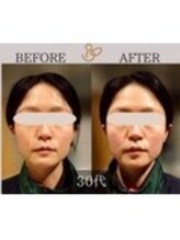 チョコバリ 錦糸町店(chocobari)/小顔×リフトアップ(美容鍼)30代