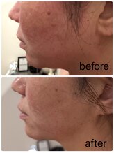 アズ(Azu)/RED SHOT