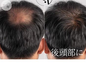 LUNEA/《症例》育毛促進