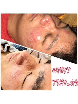 プリューム(Plume)/ニキビケアプラズマ