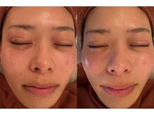 チャンプ 高の原店(Champ)/【黒ずみ対策！】毛穴洗浄ケア