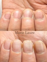 マリーロール 梅田店(Marie Laure)/自爪育成/深爪矯正/ネイルケア