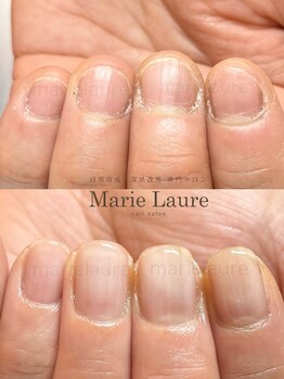 マリーロール 梅田店(Marie Laure)/自爪育成/深爪矯正/ネイルケア