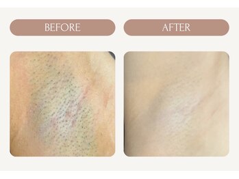 バーグトータルビューティー(bague total beauty)/ワキ脱毛