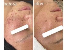 サロン ド ビューティージュエル(salon de beauty JEWEL)/プラズマニア＆光フェイシャル