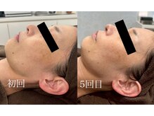 チャマ 高知店(CHAMA)/40代　水光ピール　シミ改善