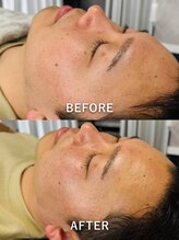 ルーク(Luke)/男性ケア/毛穴/赤み/脱毛/Wax