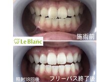ルブラン 奈良店(Le Blanc)/照射18回後