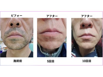 メンズ シンバ(SIMBA)/☆ ビフォーアフター ☆