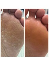 ドクターネイル爪革命 十条店/角質ケア