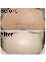 バイオビューティー 神戸本店(Bio Beauty)/ハーブピーリング症例