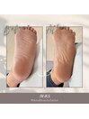 フット角質ケア