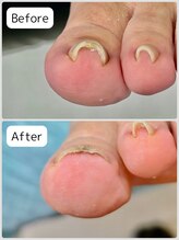 巻き爪矯正センター 沖縄 宜野湾/巻き爪矯正　