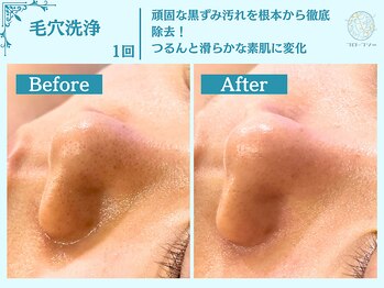 フローフシ∞/【毛穴洗浄】毛穴の黒ずみ解消