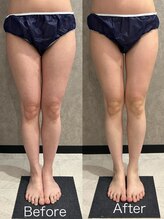 トータルビューティー ミミ(Total Beauty mimi)/一度の施術で太ももに隙間が！！