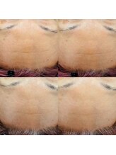 トゥインクル(Twinkle)/難しい額のシワも・・・