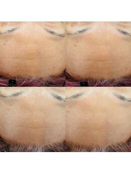 トゥインクル(Twinkle)/難しい額のシワも・・・