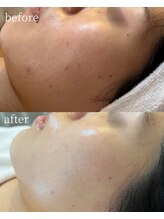 サロンナナジュウニ(Salon72)/ニキビ/肌荒れ