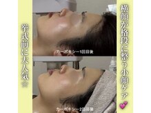 ハニエル(Haniel)/カーボキシー症例