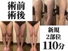 【術前/術後インディバ】お顔、腹、太もも、二の腕、豊胸等 2部位110分