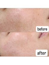 シス(SiS.)/ハーブピーリング一回目