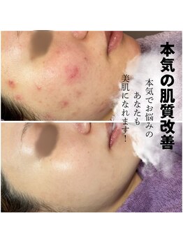 ディンプル(Dimple)/毛穴 ハーブピーリング　ニキビ