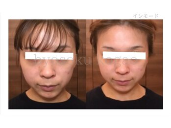 メディカルエステ 新宿南口店/*インモードリフト症例写真*