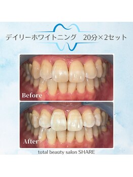 シェア(SHARE)/セルフホワイトニング