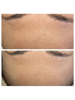 美温(mion)/水光肌の水爆弾