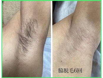 クリア 尾張旭店(Clear)/【Clear脱毛ビフォーアフター】